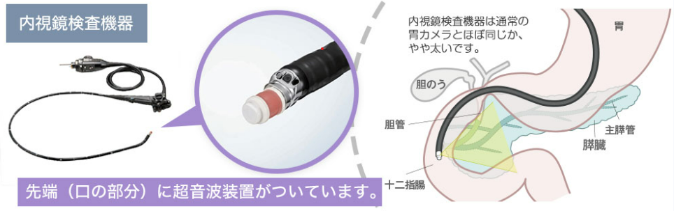 超音波内視鏡検査（EUS）イメージ